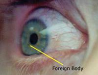 Foreign Body Eye